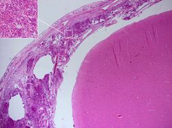 Meningitis Histopathology.jpg