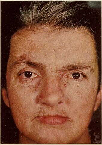 Nevoid Basal Cell Carcinoma Syndrome 4.jpg