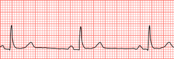 Sinus bradycardia lead2.svg