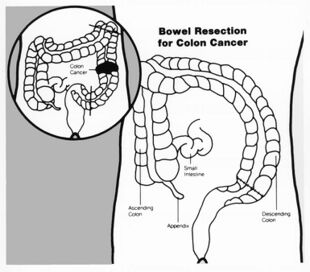 Bowel resection illustration.jpg