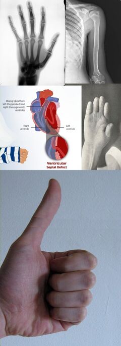 Brachydactyly-long thumb syndrome.jpg