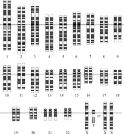 Down Syndrome karyotype.png