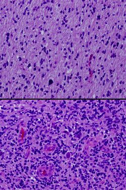 Histologic geographic variability of diffuse intrinsic pontine glioma (DIPG) - Fonc-02-00205-g003 (cropped).jpg