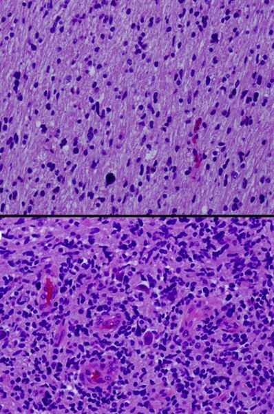 File:Histologic geographic variability of diffuse intrinsic pontine glioma (DIPG) - Fonc-02-00205-g003 (cropped).jpg