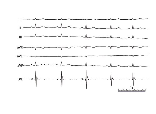 Left ventricular deflection, with bipolar esophageal electrode in left ventricular position using Butterworth highpass filtering.