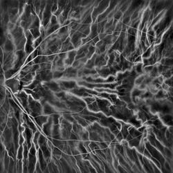 Laser Doppler holography of retinal and choroidal blood flow.jpg