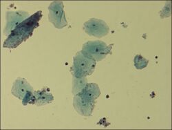 Microscopic picture of vaginal epithelial clue cells coated with Gardnerella vaginalis, magnified 400 times