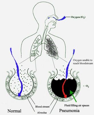 A schematic diagram of the human lungs with an empty circle on the left representing a normal alveolus and one on the right showing an alveolus full of fluid as in pneumonia