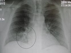 RLL pneumoniaM.jpg