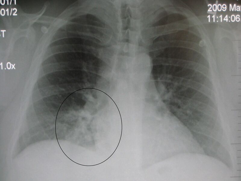 File:RLL pneumoniaM.jpg