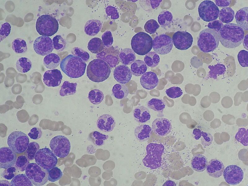 File:Chronic Myeloid Leukemia smear 2009-04-09.JPG