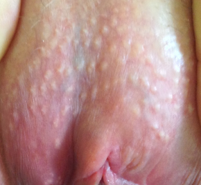 Fordyce's Spots on Vulva.png