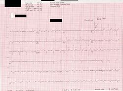 ECG Fusion beat anonimized.jpg