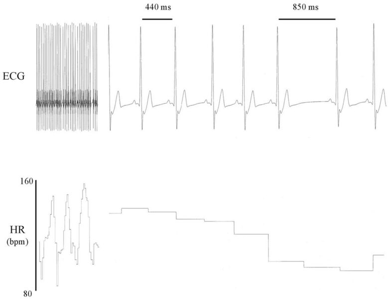 File:Heart rate variability ECG.jpg