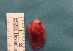 Pilonidal Cyst.png