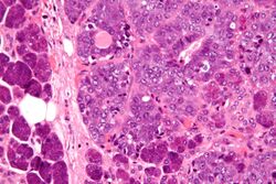 Epithelial-myoepithelial carcinoma - very high mag.jpg
