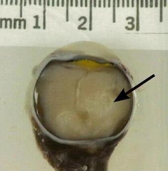 Retinoblastoma in enucleated eyeball.jpg