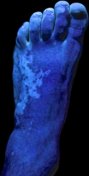 File:Vitiligo UV 2.jpg