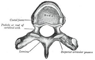 Laminectomy.jpg