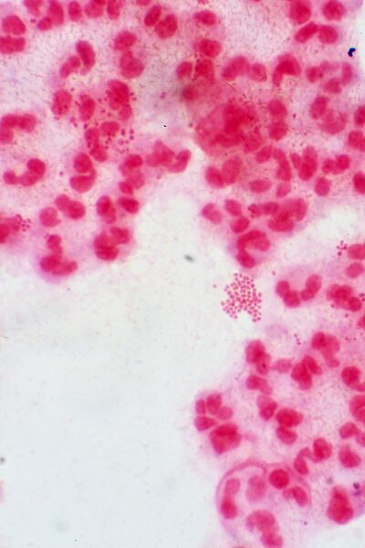 File:Neisseria gonorrhoeae with pus cells.jpg