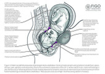 Diagram of maternal and foetal sequelae of prolonged obstructed labour, increasing the risk of obstetric fistula.