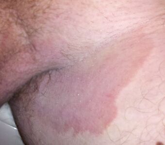 Tinea cruris.jpg