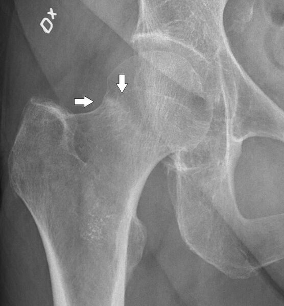 File:X-ray of subtle compressive hip fracture, labeled.jpg